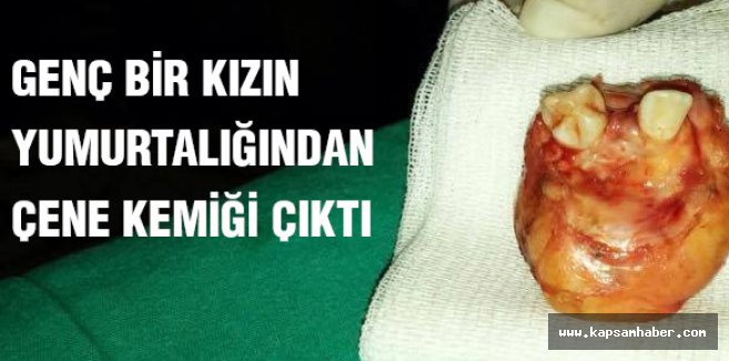 Genç kızın yumurtalığından çene kemiği...