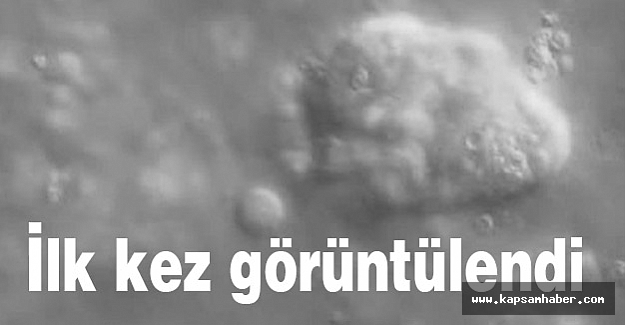 Kanserli bir tümör böyle görüntülendi