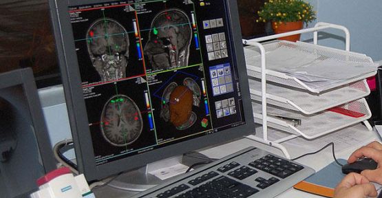 Alzheimer tedavisinde yeni umut...