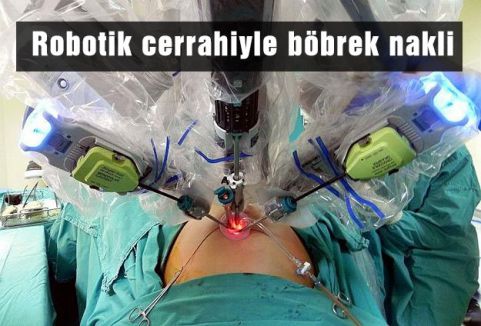 Robotik cerrahiyle böbrek nakli