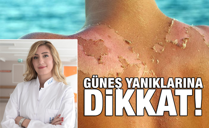 GÜNEŞ YANIKLARINA DİKKAT