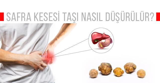 Safra Kesesi Taşı Nasıl Düşürülür?
