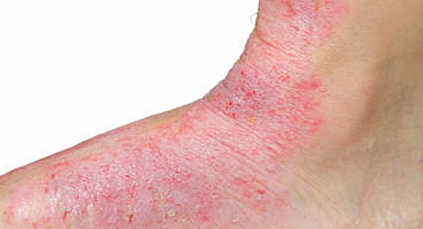Kelebek hastalığı (Lupus) Nedir?