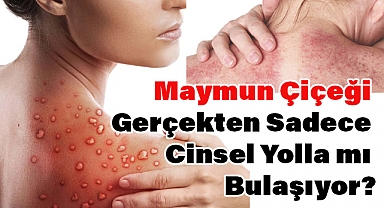 Maymun Çiçeği Virüsü Sadece Cinsel Yolla mı Bulaşıyor? Gerçekler Endişe Verici!