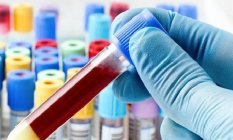 Hiv Testi Nedir ve Neden Yapılır?