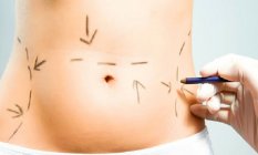 Liposuction Nedir?
