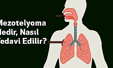 Mezotelyoma Nedir, Nasıl Tedavi Edilir?