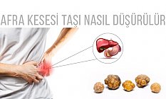 Safra Kesesi Taşı Nasıl Düşürülür?